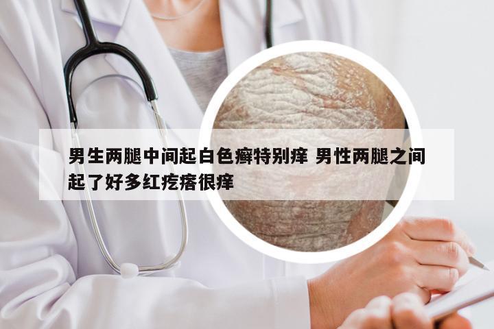 男生两腿中间起白色癣特别痒 男性两腿之间起了好多红疙瘩很痒