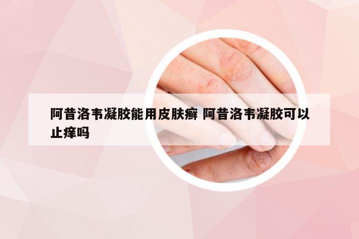 阿昔洛韦凝胶能用皮肤癣 阿昔洛韦凝胶可以止痒吗