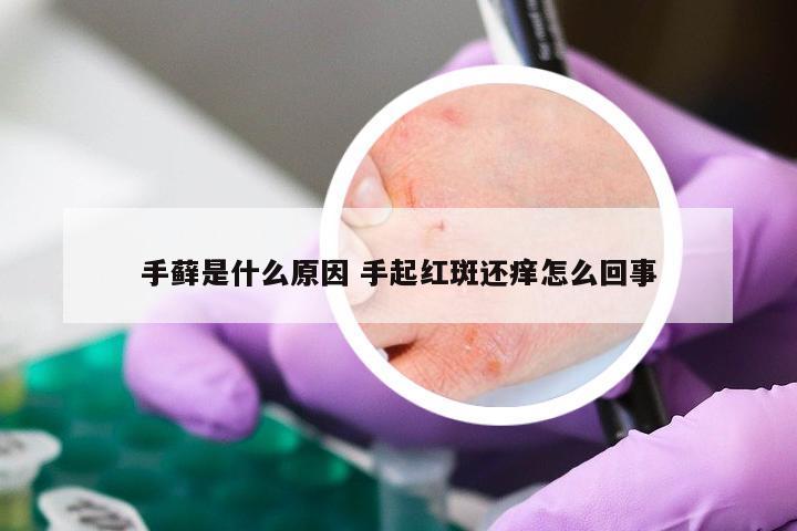 手藓是什么原因 手起红斑还痒怎么回事