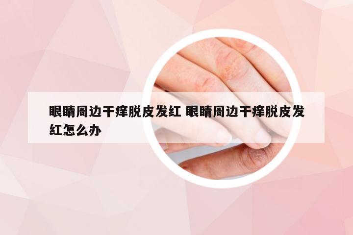 眼睛周边干痒脱皮发红 眼睛周边干痒脱皮发红怎么办