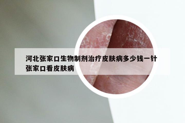 河北张家口生物制剂治疗皮肤病多少钱一针 张家口看皮肤病