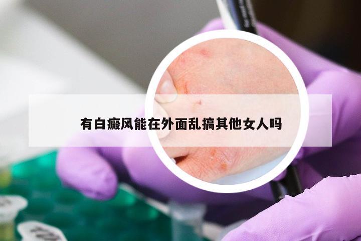 有白癜风能在外面乱搞其他女人吗