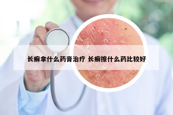 长癣拿什么药膏治疗 长癣擦什么药比较好