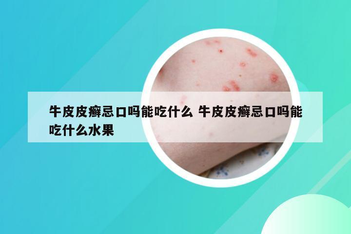 牛皮皮癣忌口吗能吃什么 牛皮皮癣忌口吗能吃什么水果