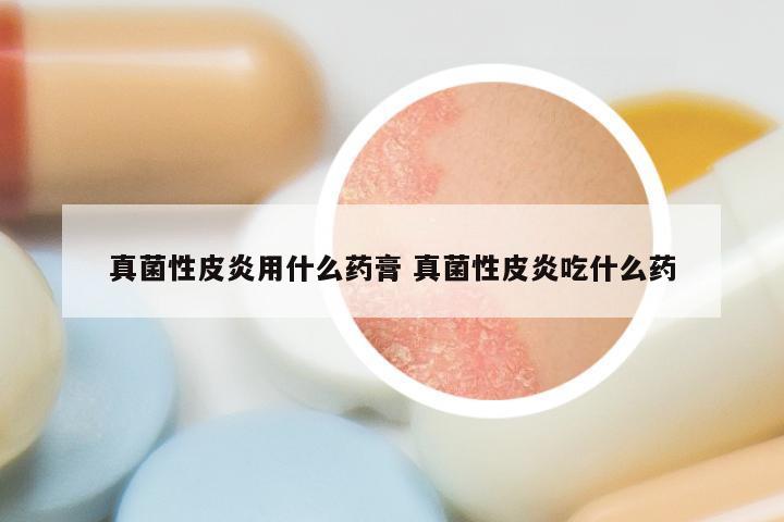 真菌性皮炎用什么药膏 真菌性皮炎吃什么药