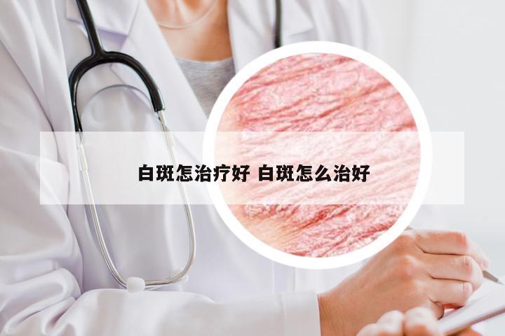 白斑怎治疗好 白斑怎么治好