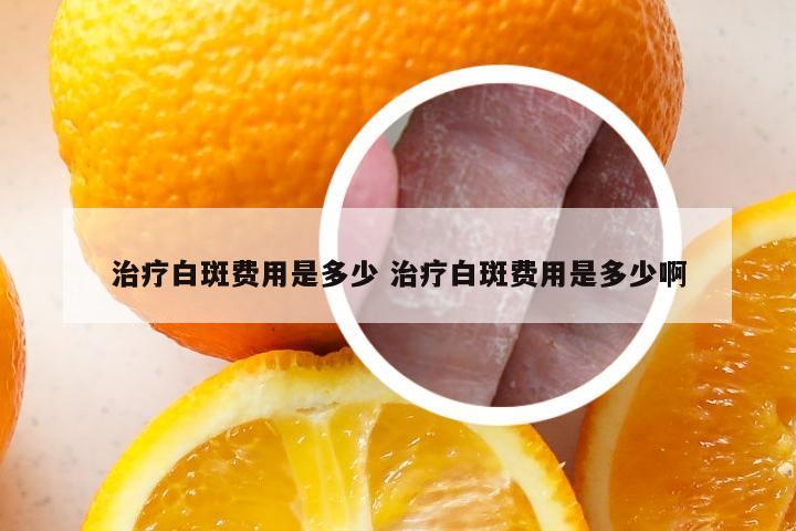 治疗白斑费用是多少 治疗白斑费用是多少啊