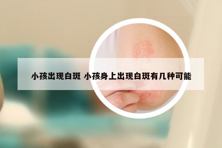 小孩出现白斑 小孩身上出现白斑有几种可能