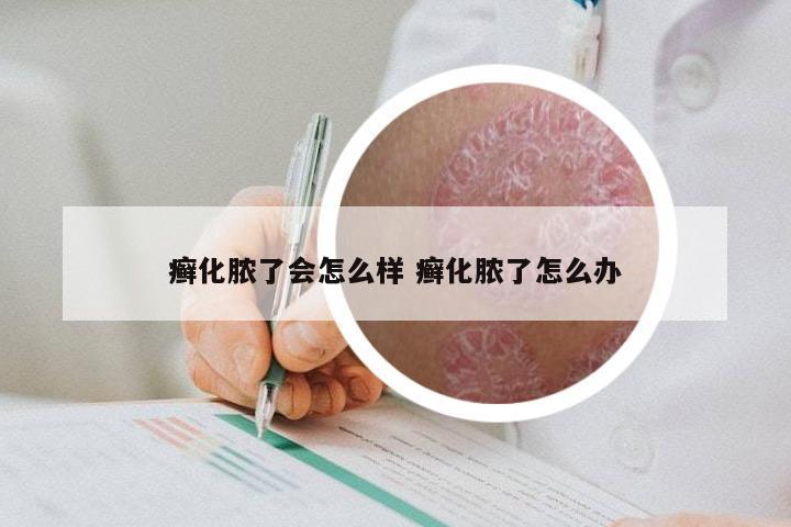 癣化脓了会怎么样 癣化脓了怎么办