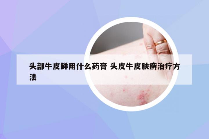 头部牛皮鲜用什么药膏 头皮牛皮肤癣治疗方法