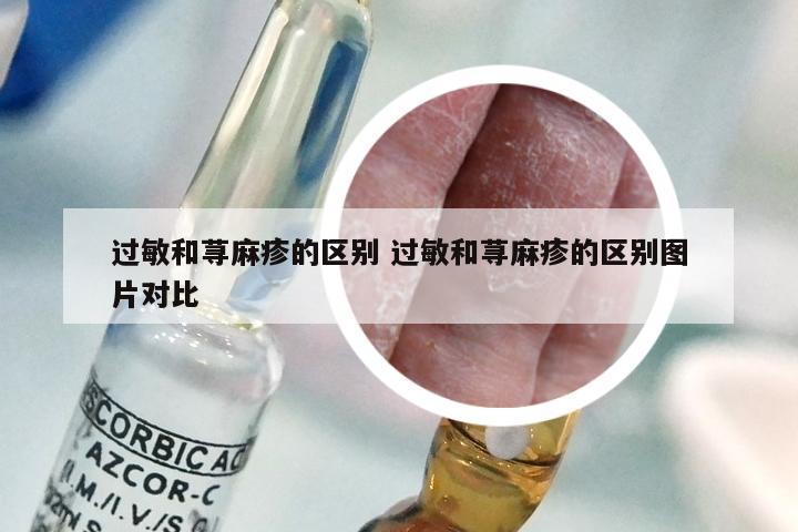 过敏和荨麻疹的区别 过敏和荨麻疹的区别图片对比