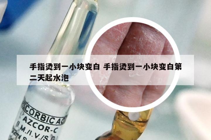 手指烫到一小块变白 手指烫到一小块变白第二天起水泡