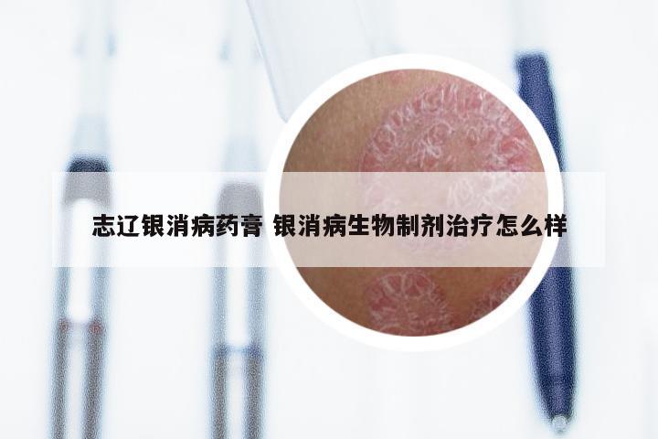 志辽银消病药膏 银消病生物制剂治疗怎么样