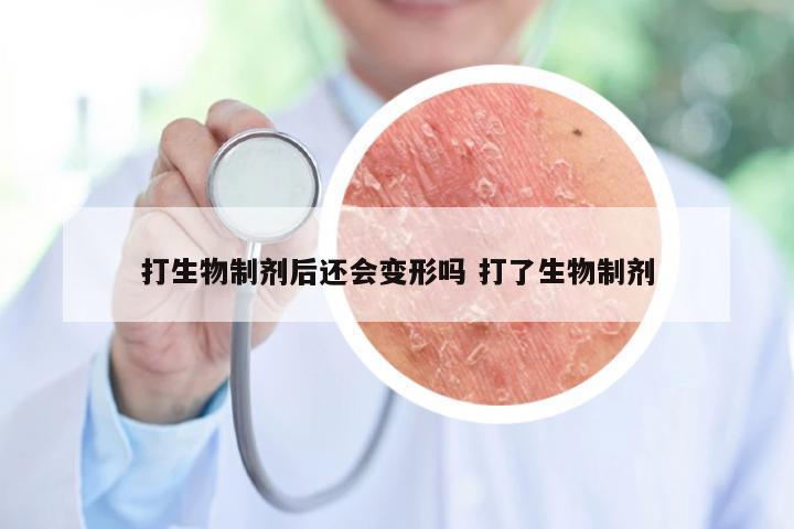 打生物制剂后还会变形吗 打了生物制剂