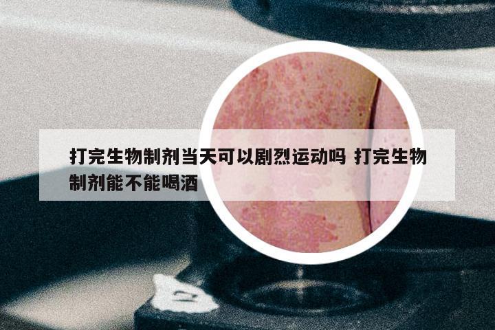 打完生物制剂当天可以剧烈运动吗 打完生物制剂能不能喝酒