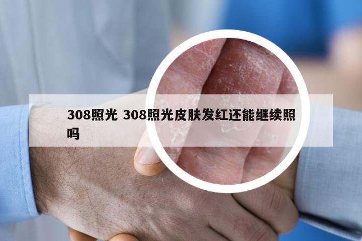 308照光 308照光皮肤发红还能继续照吗