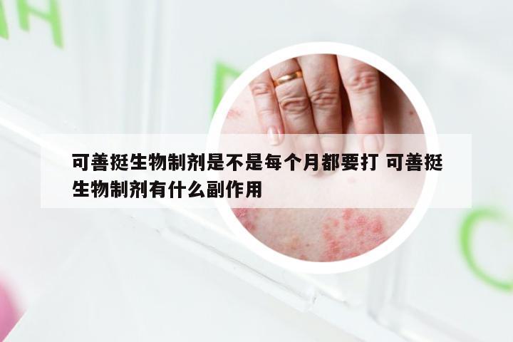 可善挺生物制剂是不是每个月都要打 可善挺生物制剂有什么副作用