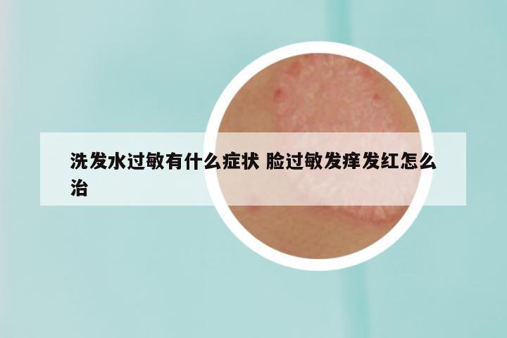 洗发水过敏有什么症状 脸过敏发痒发红怎么治