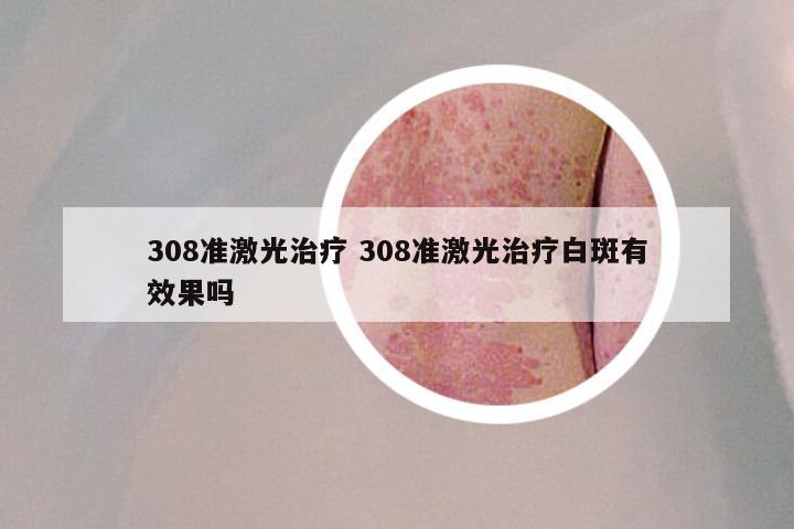 308准激光治疗 308准激光治疗白斑有效果吗