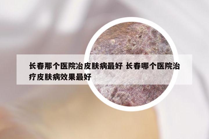 长春那个医院冶皮肤病最好 长春哪个医院治疗皮肤病效果最好