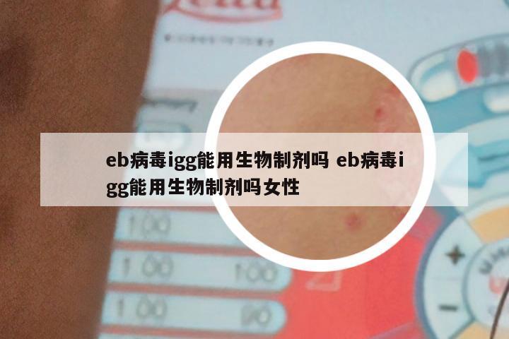 eb病毒igg能用生物制剂吗 eb病毒igg能用生物制剂吗女性