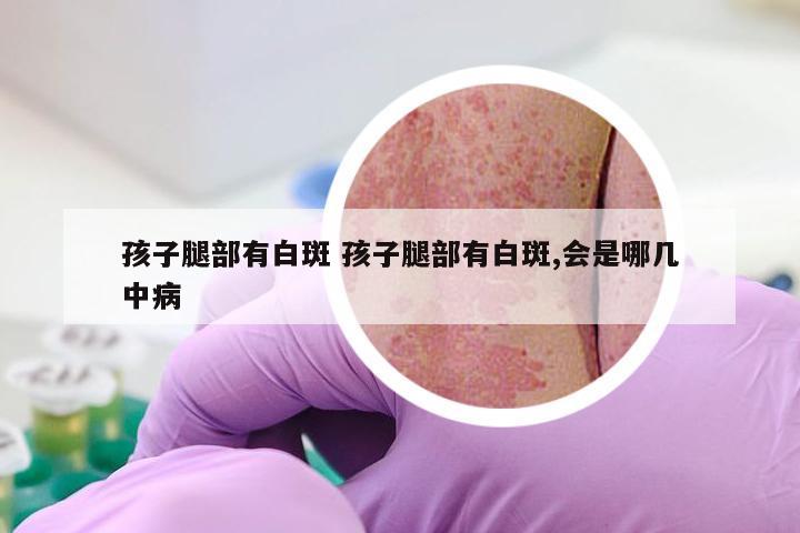 孩子腿部有白斑 孩子腿部有白斑,会是哪几中病