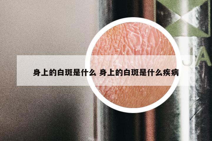 身上的白斑是什么 身上的白斑是什么疾病