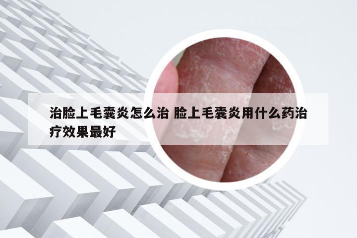 治脸上毛囊炎怎么治 脸上毛囊炎用什么药治疗效果最好