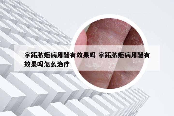 掌跖脓疱病用醋有效果吗 掌跖脓疱病用醋有效果吗怎么治疗