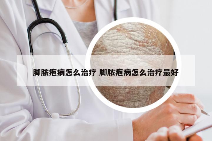 脚脓疱病怎么治疗 脚脓疱病怎么治疗最好