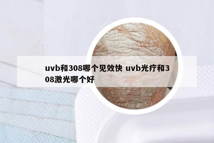 uvb和308哪个见效快 uvb光疗和308激光哪个好