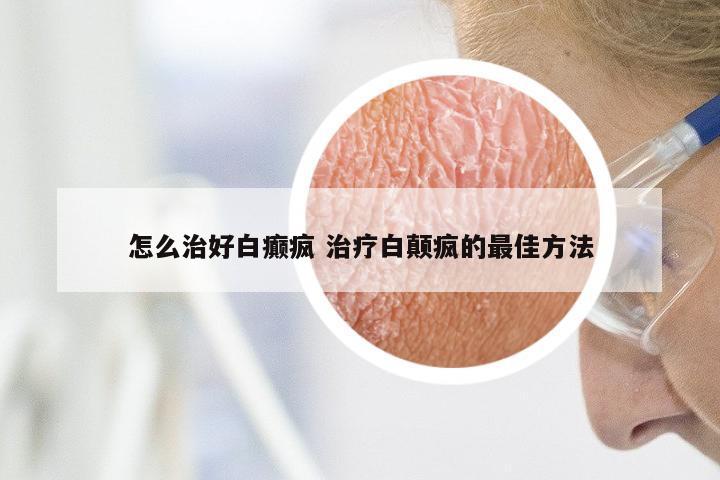 怎么治好白癫疯 治疗白颠疯的最佳方法