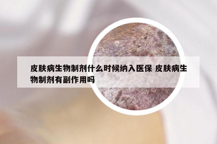 皮肤病生物制剂什么时候纳入医保 皮肤病生物制剂有副作用吗