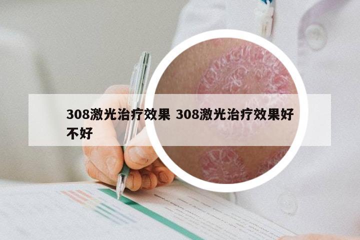 308激光治疗效果 308激光治疗效果好不好