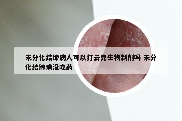 未分化结缔病人可以打云克生物制剂吗 未分化结缔病没吃药