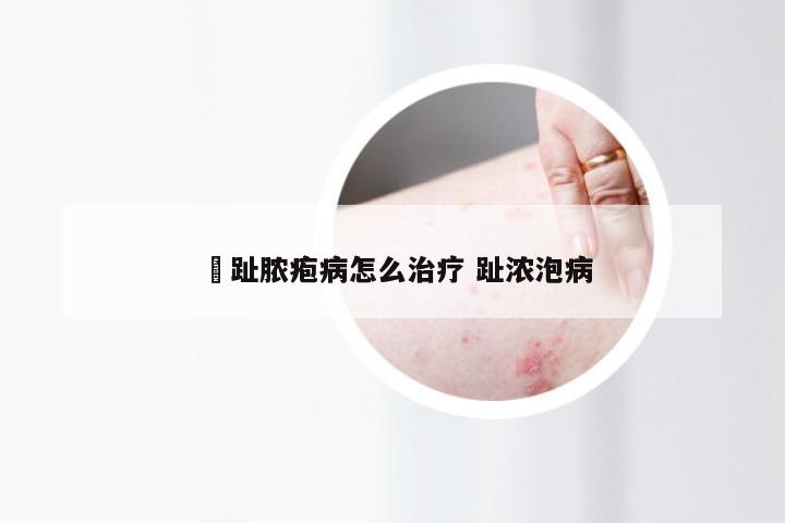 礃趾脓疱病怎么治疗 趾浓泡病