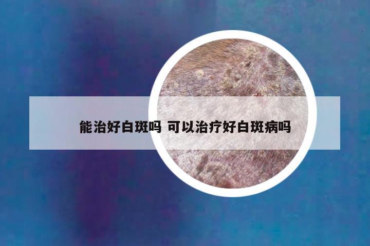 能治好白斑吗 可以治疗好白斑病吗