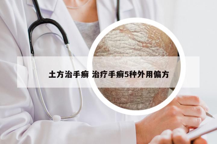 土方治手癣 治疗手癣5种外用偏方