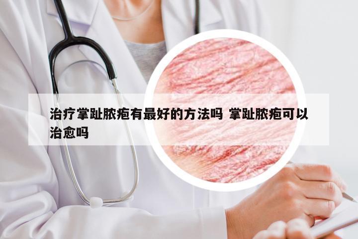 治疗掌趾脓疱有最好的方法吗 掌趾脓疱可以治愈吗