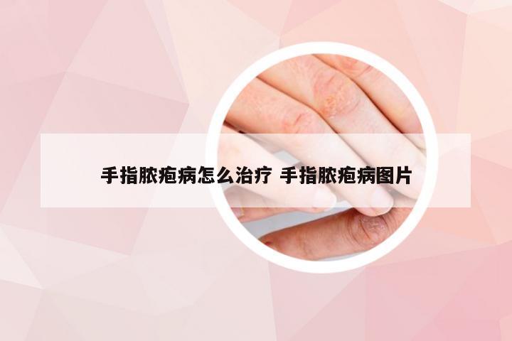 手指脓疱病怎么治疗 手指脓疱病图片