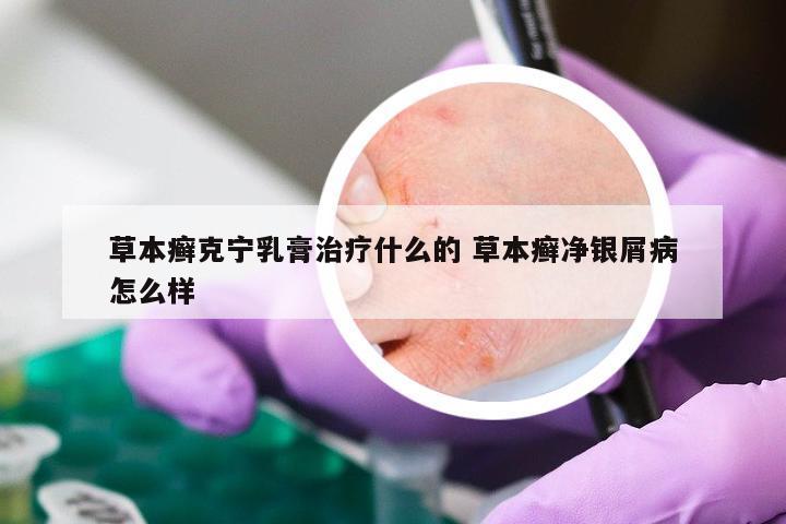 草本癣克宁乳膏治疗什么的 草本癣净银屑病怎么样