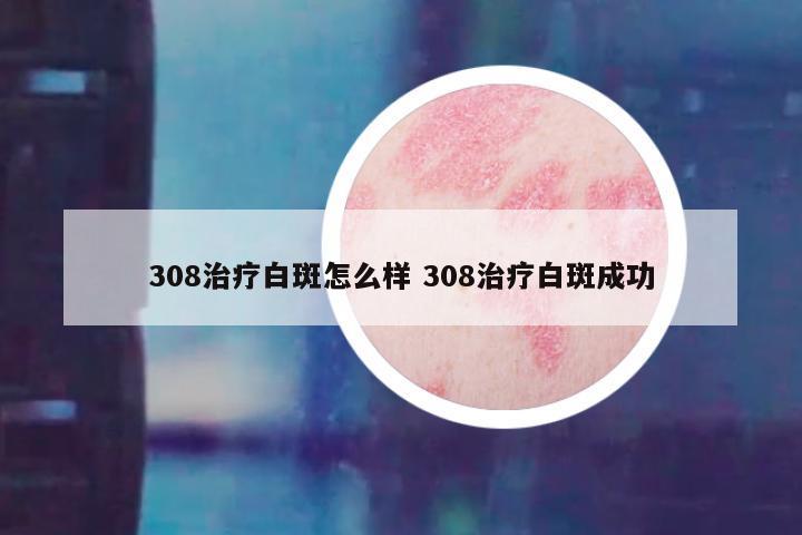 308治疗白斑怎么样 308治疗白斑成功