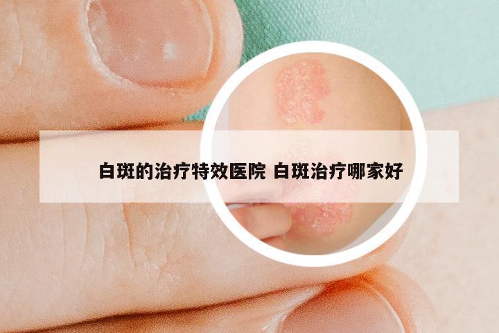 白斑的治疗特效医院 白斑治疗哪家好