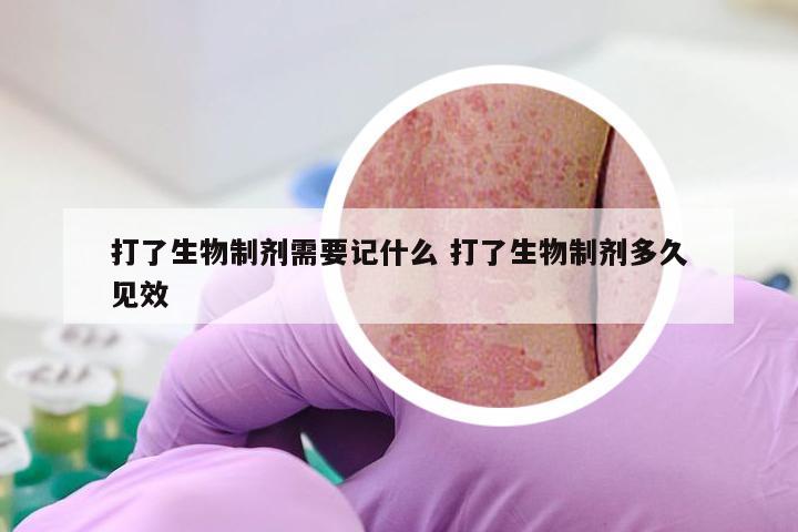 打了生物制剂需要记什么 打了生物制剂多久见效