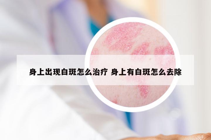 身上出现白斑怎么治疗 身上有白斑怎么去除