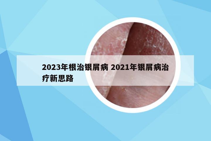 2023年根治银屑病 2021年银屑病治疗新思路