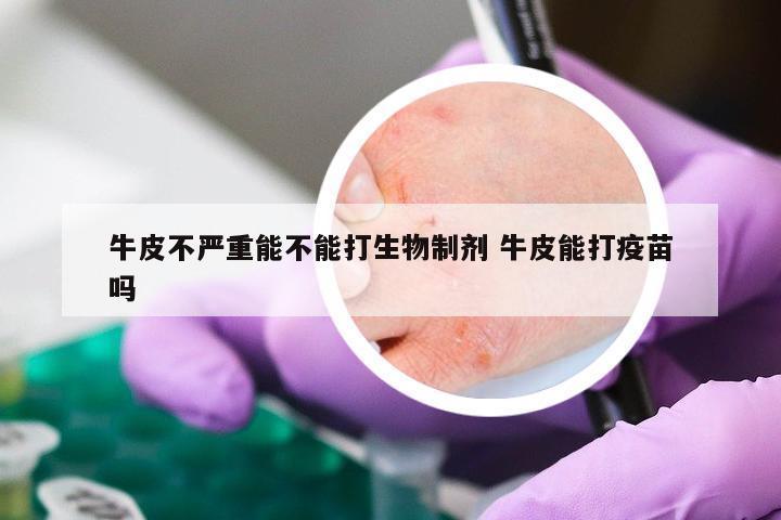 牛皮不严重能不能打生物制剂 牛皮能打疫苗吗