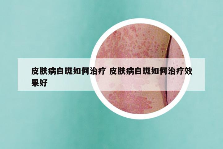 皮肤病白斑如何治疗 皮肤病白斑如何治疗效果好