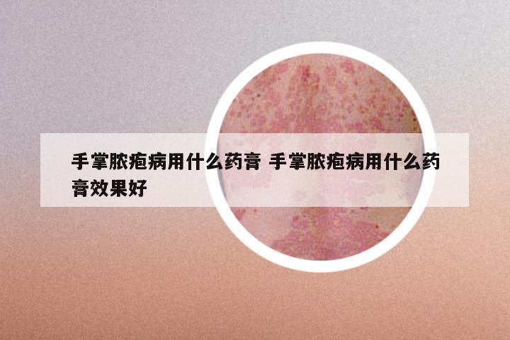 手掌脓疱病用什么药膏 手掌脓疱病用什么药膏效果好