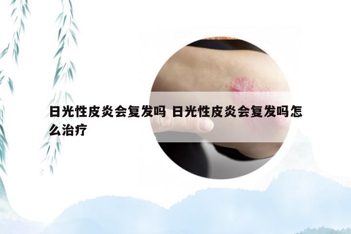 日光性皮炎会复发吗 日光性皮炎会复发吗怎么治疗